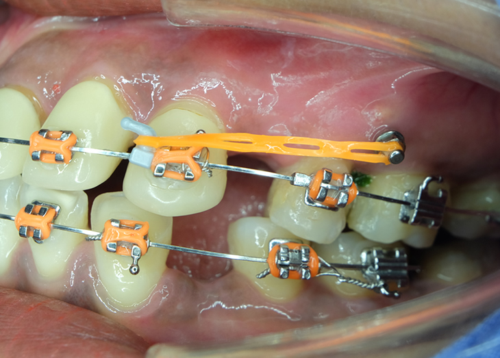 インプラント矯正
